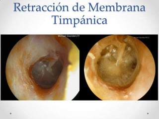 Retracción de Membrana
Timpánica

 
