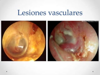 Lesiones vasculares

 