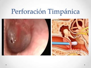 Perforación Timpánica

 