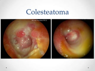 Colesteatoma

 