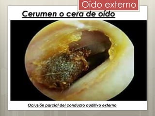 Cerumen o cera de oído
Oclusión parcial del conducto auditivo externo
Oído externo
 