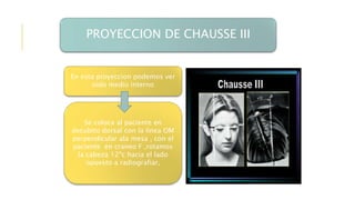 PROYECCION DE CHAUSSE III
En esta proyeccion podemos ver
oido medio interno
Se coloca al paciente en
decubito dorsal con la linea OM
perpendicular ala mesa , con el
paciente en craneo F ,rotamos
la cabeza 12ºc hacia el lado
opuesto a radiografiar,
 