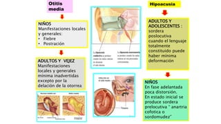 Otitis
media
NIÑOS
Manifestaciones locales
y generales:
• Fiebre
• Postración
ADULTOS Y VEJEZ
Manifestaciones
locales y generales
mínima inadvertidas
excepto por la
delación de la otorrea
Hipoacusia
ADULTOS Y
ADOLESCENTES :
sordera
poslocutiva
cuando el lenguaje
totalmente
constituido puede
haber mínima
deformación
NIÑOS
En fase adelantada
poca distorsión.
En estado inicial se
produce sordera
prelocutiva “ anartria
cofotica o
sordomudez”
 