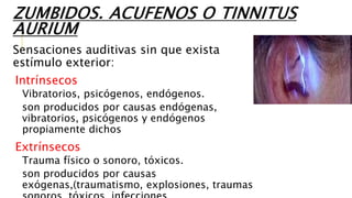 ZUMBIDOS. ACUFENOS O TINNITUS
AURIUM
Sensaciones auditivas sin que exista
estímulo exterior:
Intrínsecos
Vibratorios, psicógenos, endógenos.
son producidos por causas endógenas,
vibratorios, psicógenos y endógenos
propiamente dichos
Extrínsecos
Trauma físico o sonoro, tóxicos.
son producidos por causas
exógenas,(traumatismo, explosiones, traumas
 