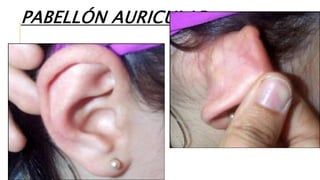 PABELLÓN AURICULAR
 