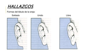 HALLAZGOS
Formas del lóbulo de la oreja:
Soldado Unido Libre
 