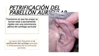 PETRIFICACIÓN DEL
PABELLÓN AURICULAR
Transtorno en que las orejas se
tornan total o parcialmente
rígidas con una consistencia
pétrea del cartílago auricular
La causa más frecuente es la
calcificación del cartílago auricular
e infrecuentemente la osificación
auricular.
 