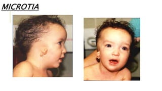 MICROTIA
 