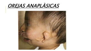 OREJAS ANAPLÀSICAS
 