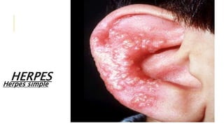 HERPES
Herpes simple
 