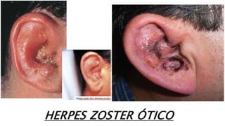 HERPES ZOSTER ÓTICO
 