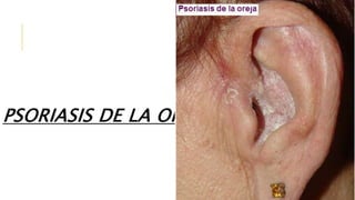 PSORIASIS DE LA OREJA
 