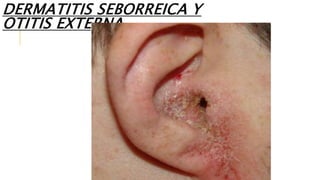 DERMATITIS SEBORREICA Y
OTITIS EXTERNA
 
