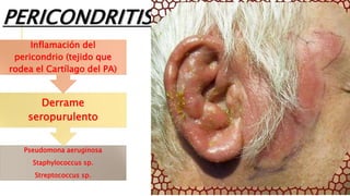 Pseudomona aeruginosa
Staphylococcus sp.
Streptococcus sp.
Derrame
seropurulento
Inflamación del
pericondrio (tejido que
rodea el Cartílago del PA)
PERICONDRITIS
 
