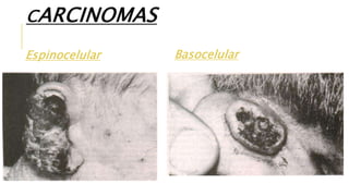 CARCINOMAS
Espinocelular Basocelular
 