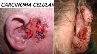 CARCINOMA CELULAR
 