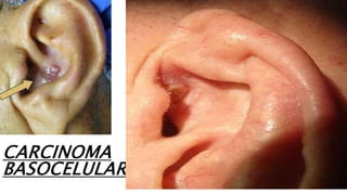 CARCINOMA
BASOCELULAR
 