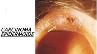 CARCINOMA
EPIDERMOIDE
 