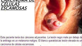 CARCINOMA DE
CÉLULAS
ESCAMOSAS
 