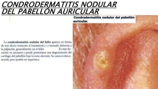 CONDRODERMATITIS NODULAR
DEL PABELLÓN AURICULAR
 