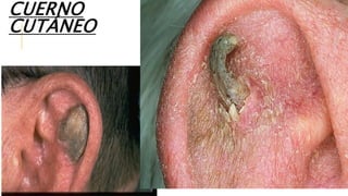 CUERNO
CUTÁNEO
 