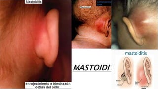 MASTOIDITIS
 