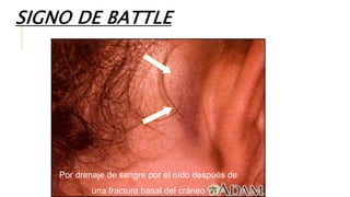 SIGNO DE BATTLE
Por drenaje de sangre por el oído después de
una fractura basal del cráneo
 