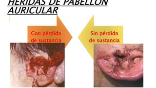 Con pérdida
de sustancia
Sin pérdida
de sustancia
HERIDAS DE PABELLÓN
AURICULAR
 
