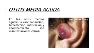 OTITIS MEDIA AGUDA
En las otitis medias
agudas la vascularización,
tumefacción, infiltración y
abombamiento son
manifestaciones claras.
 