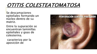 OTITIS COLESTEATOMATOSA
Se descamaciones
epiteliales formando un
núcleo dentro de su
matriz.
Entre la supuración se
encuentran laminillas
epiteliales y goas de
colesterina.
caracteriza por la
aposición de
 