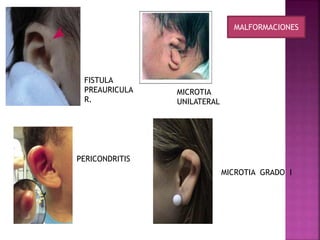 MICROTIA 
UNILATERAL 
PERICONDRITIS 
MICROTIA GRADO I 
FISTULA 
PREAURICULA 
R. 
MALFORMACIONES 
 