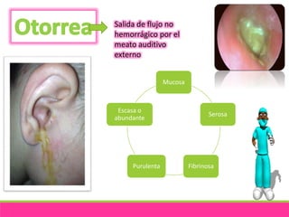 Salida de flujo no 
hemorrágico por el 
meato auditivo 
externo 
Mucosa 
Serosa 
Escasa o 
abundante 
Purulenta Fibrinosa 
 