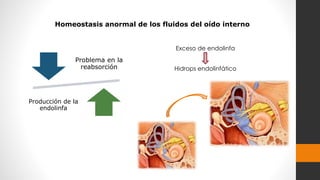 Homeostasis anormal de los fluidos del oído interno
Problema en la
reabsorción
Producción de la
endolinfa
Exceso de endolinfa
Hidrops endolinfático
 