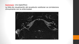 Radiología: (no específico)
La falta de visualización del acueducto vestibular se correlaciona
clínicamente con la enfermedad.
 