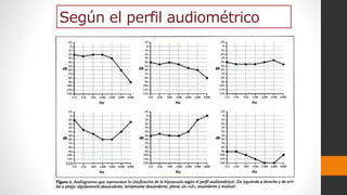 Según el perfil audiométrico
 