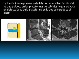 La hernia intraesponjosa o de Schmorl es una herniación del
núcleo pulposo en las plataformas vertebrales lo que provoca
un defecto óseo de la plataforma en la que se introduce el
disco
 