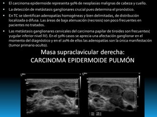  El carcinoma epidermoide representa 90% de neoplasias malignas de cabeza y cuello.
 La detección de metástasis ganglionares crucial pues determina el pronóstico.
 EnTC se identifican adenopatías homogéneas y bien delimitadas, de distribución
localizada o difusa. Las áreas de baja atenuación (necrosis) son poco frecuentes en
pacientes no tratados.
 Las metástasis ganglionares cervicales del carcinoma papilar de tiroides son frecuentes(
yugular inferior nivel IV). En el 50% casos se aprecia una afectación ganglionar en el
momento del diagnóstico y en el 20% de ellos las adenopatías son la única manifestación
(tumor primario oculto).
 