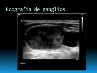 Ecografia de ganglios
 