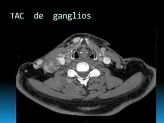 TAC de ganglios
 