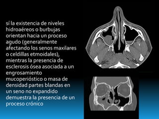 sí la existencia de niveles
hidroaéreos o burbujas
orientan hacia un proceso
agudo (generalmente
afectando los senos maxilares
o celdillas etmoidales),
mientras la presencia de
esclerosis ósea asociada a un
engrosamiento
mucoperióstico o masa de
densidad partes blandas en
un seno no expandido
demuestra la presencia de un
proceso crónico
 