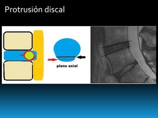 Protrusión discal
 