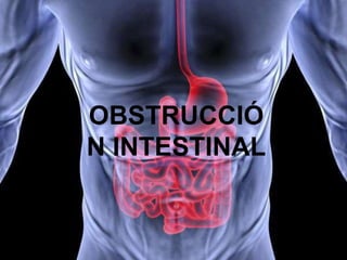 OCLUSIÓN INTESTINAL | PPTX