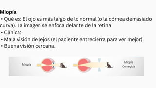 Miopía
• Qué es: El ojo es más largo de lo normal (o la córnea demasiado
curva). La imagen se enfoca delante de la retina.
• Clínica:
• Mala visión de lejos (el paciente entrecierra para ver mejor).
• Buena visión cercana.
 