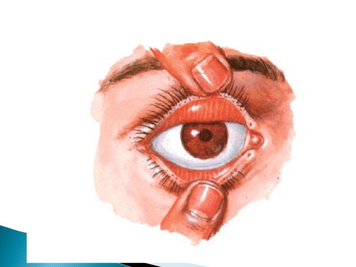 Слизистая оболочка век. Конъюнктивальный мешок глаза. Верхний конъюнктивальный мешок анатомия. Тарзальная конъюнктива. Строение глаза человека конъюнктивальный мешок.
