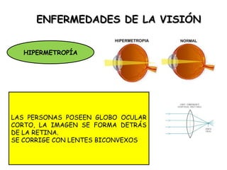EENNFFEERRMMEEDDAADDEESS DDEE LLAA VVIISSIIÓÓNN 
HIPERMETROPÍA 
LAS PERSONAS POSEEN GLOBO OCULAR 
CORTO, LA IMAGEN SE FORMA DETRÁS 
DE LA RETINA. 
SE CORRIGE CON LENTES BICONVEXOS 
 