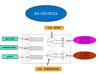 EN SÍNTESIS 
EMETROPÍA 
HIPERMETROPÍA 
MIOPÍA 
OJO MIOPE 
OJO HIPERMÉTROPE 
SE CORRIGE 
CON LENTES 
BICÓNCAVOS 
SE CORRIGE 
CON LENTES 
BICONVEXOS 
 