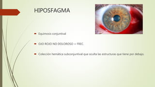 HIPOSFAGMA
 Equimosis conjuntival
 OJO ROJO NO DOLOROSO + FREC.
 Colección hemática subconjuntival que oculta las estructuras que tiene por debajo.
 