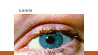 BLEFARITIS
 