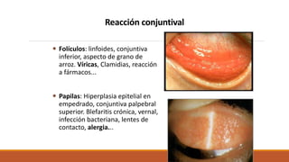 Reacción conjuntival
 Folículos: linfoides, conjuntiva
inferior, aspecto de grano de
arroz. Víricas, Clamidias, reacción
...