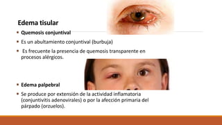 Edema tisular
 Quemosis conjuntival
 Es un abultamiento conjuntival (burbuja)
 Es frecuente la presencia de quemosis tr...